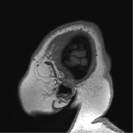 Cerebellopontine angle meningioma (Radiopaedia 48434-53348 Sagittal T1 10).png