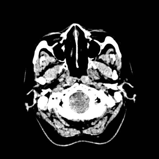Cerebellopontine angle meningioma (Radiopaedia 53561-59592 Axial non-contrast 7).jpg