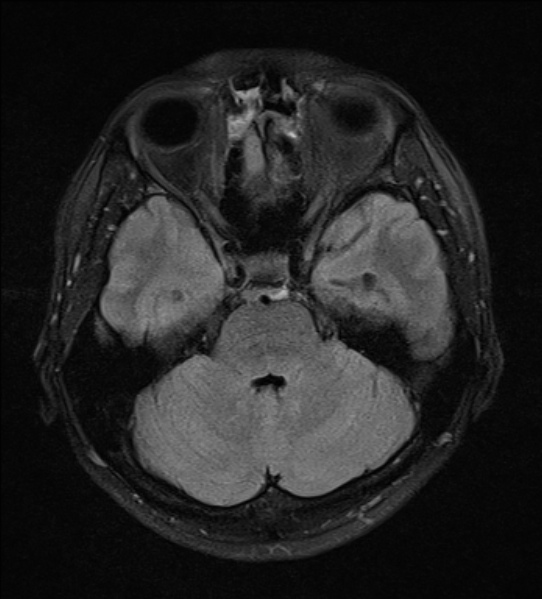 File:Cerebral abscess (Radiopaedia 24212-24478 Axial FLAIR 7).jpg