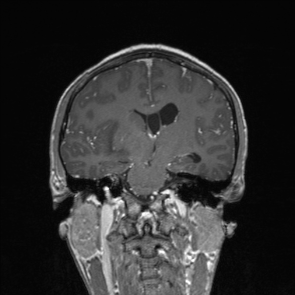 Cerebral abscess (Radiopaedia 24212-24478 Coronal T1 C+ 115).jpg