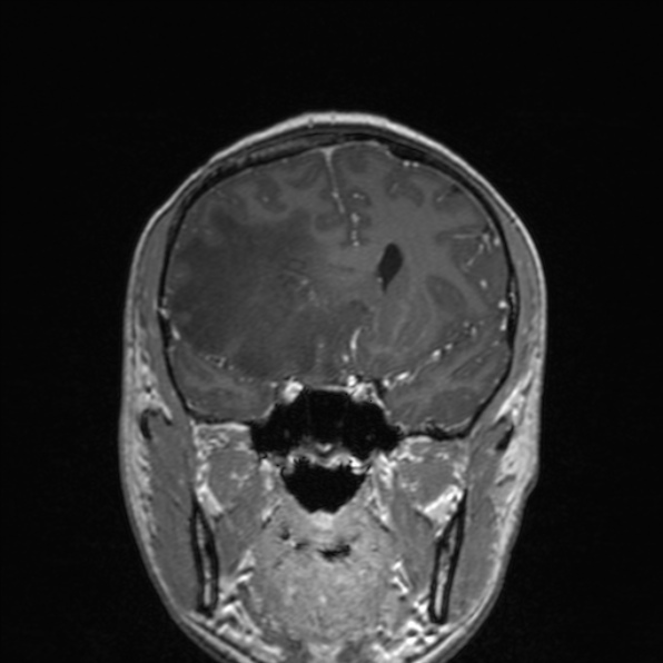 Cerebral abscess (Radiopaedia 24212-24478 Coronal T1 C+ 88).jpg