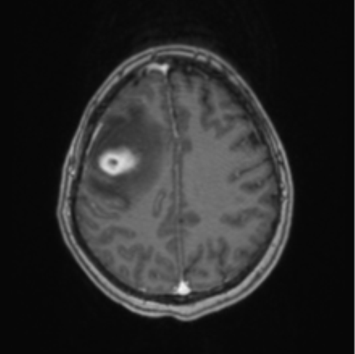Cerebral abscess from pulmonary arteriovenous malformation (Radiopaedia 86275-102291 Axial T1 C+ 54).png