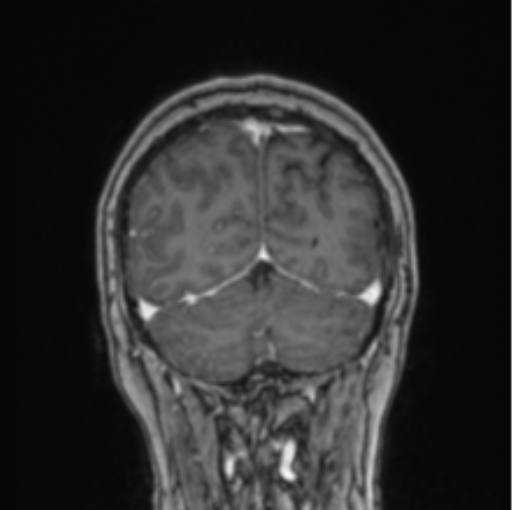 Cerebral abscess from pulmonary arteriovenous malformation (Radiopaedia 86275-102291 L 22).png