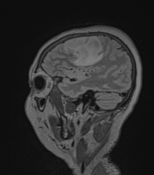 Cerebral abscess from pulmonary arteriovenous malformation (Radiopaedia 86275-102291 Sagittal FLAIR 57).png