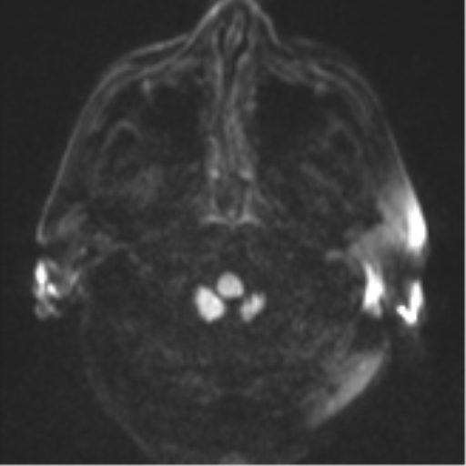 Cerebral abscesses- medically managed (Radiopaedia 45183-49179 Axial DWI 31).png