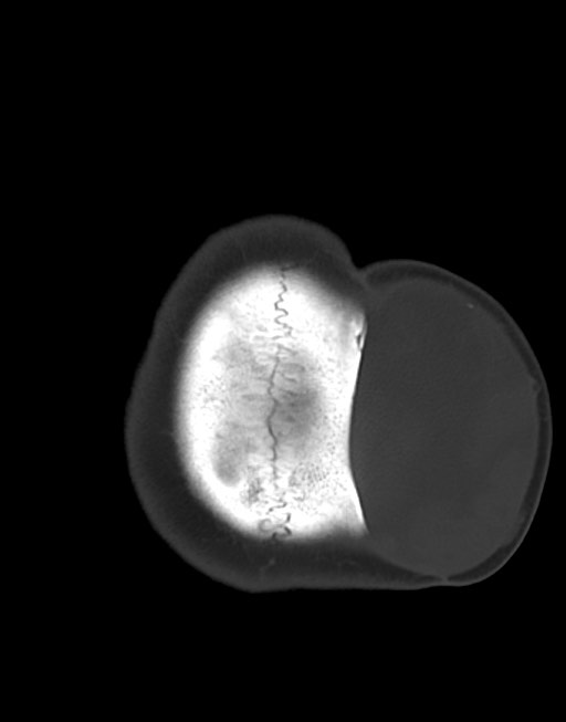 Cerebral abscesses (Radiopaedia 70458-80568 Axial bone window 55).jpg