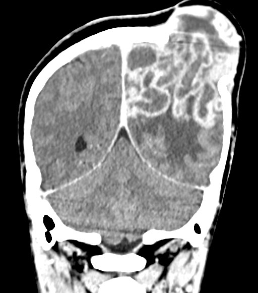 Cerebral abscesses (Radiopaedia 70458-80568 Coronal Contrast 49).jpg