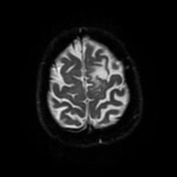 Cerebral amyloid angiopathy (Radiopaedia 28698-28978 Axial DWI 54).jpg