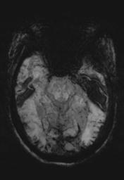 File:Cerebral amyloid angiopathy (Radiopaedia 29129-29518 Axial SWI MIP 10).jpg