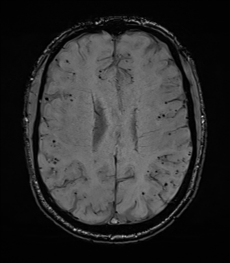 Cerebral amyloid angiopathy (Radiopaedia 46082-50433 Axial SWI 54).png