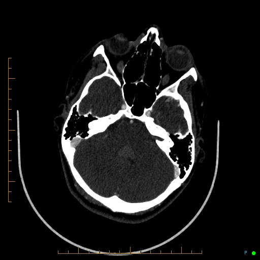Cerebral arteriovenous malformation (AVM) (Radiopaedia 78162-90706 Axial CTA 87).jpg