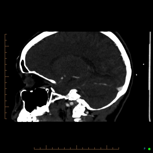 Cerebral arteriovenous malformation (AVM) (Radiopaedia 78162-90706 Sagittal CTA 51).jpg