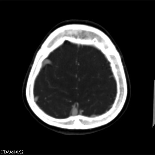 Cerebral arteriovenous malformation (Radiopaedia 28518-28759 B 52).jpg