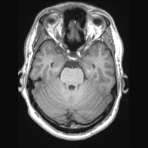 Cerebral arteriovenous malformation (Radiopaedia 39259-41506 Axial T1 26).png
