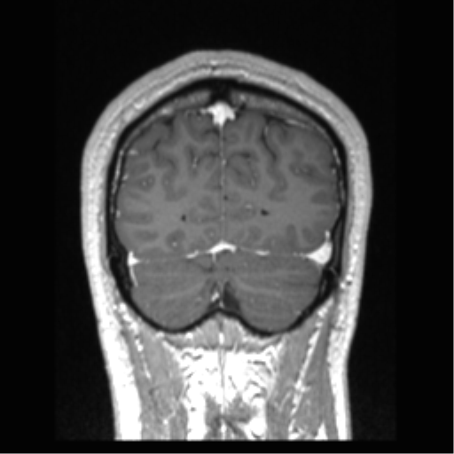 Cerebral arteriovenous malformation (Radiopaedia 39259-41506 Coronal T1 C+ 19).png
