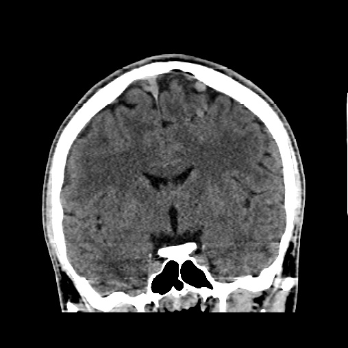 Cerebral arteriovenous malformation (Radiopaedia 61964-70028 Coronal non-contrast 28).jpg