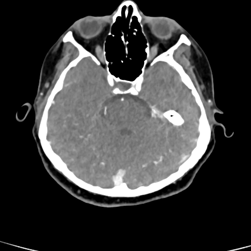 Cerebral arteriovenous malformation (Radiopaedia 73830-84645 B 69).jpg
