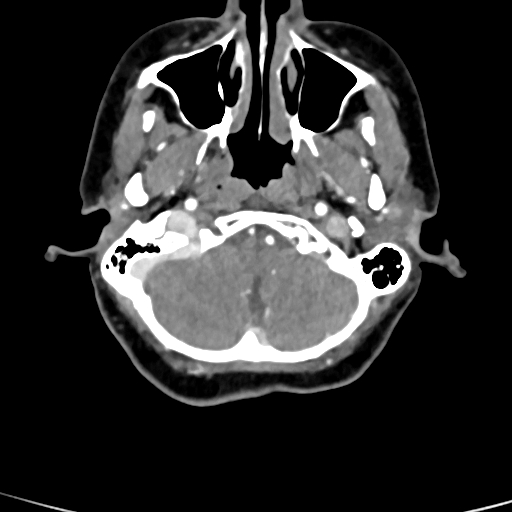 Cerebral arteriovenous malformation (Radiopaedia 73830-84645 B 87).jpg