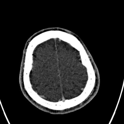 Cerebral arteriovenous malformation (Radiopaedia 78188-90746 Axial C+ delayed 147).jpg