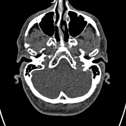 Cerebral arteriovenous malformation (Radiopaedia 78188-90746 Axial non-contrast 30).jpg