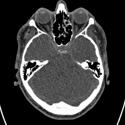 Cerebral arteriovenous malformation (Radiopaedia 78188-90746 Axial non-contrast 53).jpg