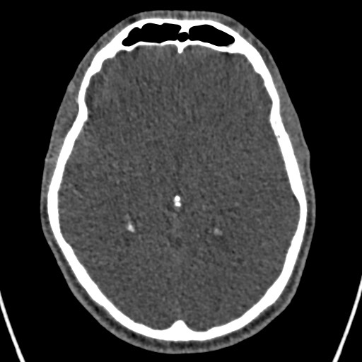 Cerebral arteriovenous malformation (Radiopaedia 78188-90746 Axial non-contrast 87).jpg
