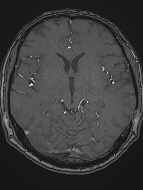 File:Cerebral arteriovenous malformation (Radiopaedia 84015-99245 Axial TOF 120).jpg