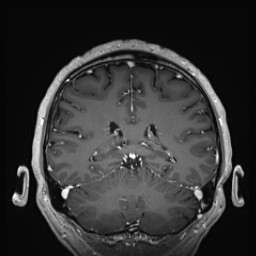 Cerebral arteriovenous malformation (Radiopaedia 84015-99245 Coronal T1 C+ 107).jpg