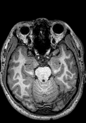 Cerebral arteriovenous malformation at posterior body of corpus callosum (Radiopaedia 74111-84925 Axial T1 202).jpg