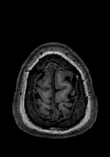 Cerebral arteriovenous malformation at posterior body of corpus callosum (Radiopaedia 74111-84925 Axial T1 7).jpg