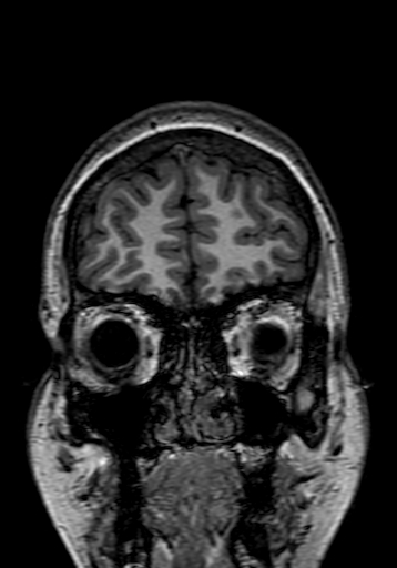 Cerebral arteriovenous malformation at posterior body of corpus callosum (Radiopaedia 74111-84925 Coronal T1 25).jpg