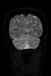 Cerebral arteriovenous malformation at posterior body of corpus callosum (Radiopaedia 74111-84925 Coronal T2 153).jpg