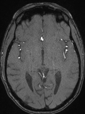 Cerebral arteriovenous malformation with hemorrhage (Radiopaedia 34422-35737 Axial MRA 39).png