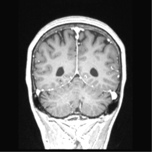 Cerebral arteriovenous malformation with hemorrhage (Radiopaedia 34422-35737 Coronal T1 C+ 27).png