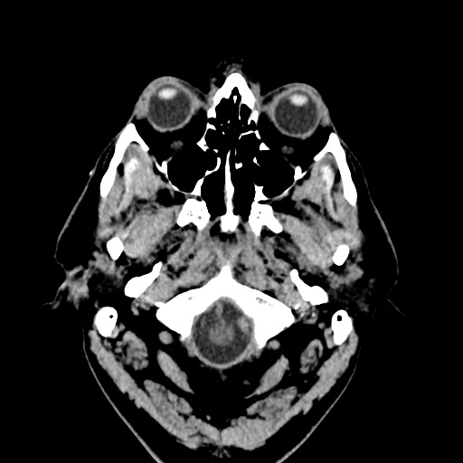 Cerebral arteriovenous malformation with lobar hemorrhage (Radiopaedia 35598-37117 Axial non-contrast 1).jpg