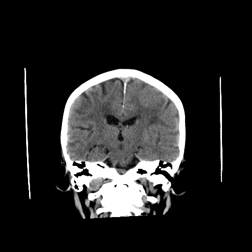 File:Cerebral arteriovenous malformation with lobar hemorrhage (Radiopaedia 44725-48512 Axial non-contrast 1).png