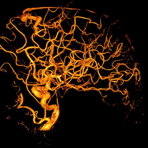 Cerebral arteriovenous malformation with lobar hemorrhage (Radiopaedia 44725-48513 Lateral 48).png
