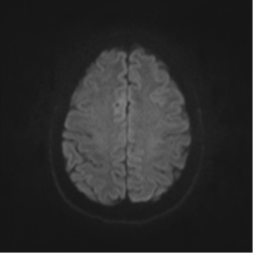 File:Cerebral cavernoma and development venous anomaly (Radiopaedia 37603-39482 Axial DWI 40).png