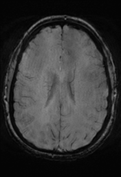 File:Cerebral cavernoma and development venous anomaly (Radiopaedia 37603-39482 Axial SWI 25).png