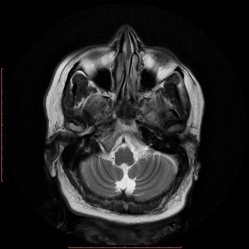 File:Cerebral cavernous malformation (Radiopaedia 26177-26306 Axial T2 5).jpg