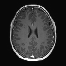 Cerebral cavernous venous malformation (Radiopaedia 70008-80021 Axial T1 C+ 54).jpg