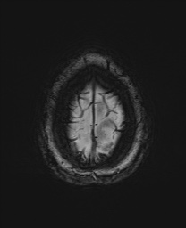 Cerebral cavernous venous malformation (Radiopaedia 70008-80021 I 70).jpg