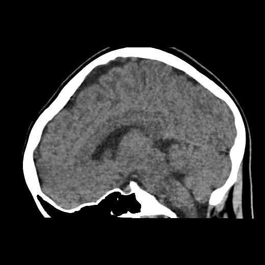 File:Cerebral cavernous venous malformation (Radiopaedia 70008-80022 C 31).jpg