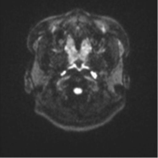 Cerebral cavernous venous malformations (Radiopaedia 48117-52946 Axial DWI 28).png