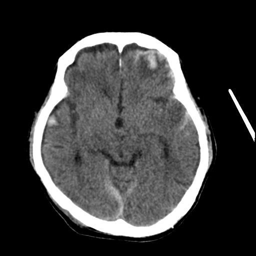 File:Cerebral contusions, subarachnoid hemorrhage and subdural hygromas (Radiopaedia 55399-61827 Axial non-contrast 16).png
