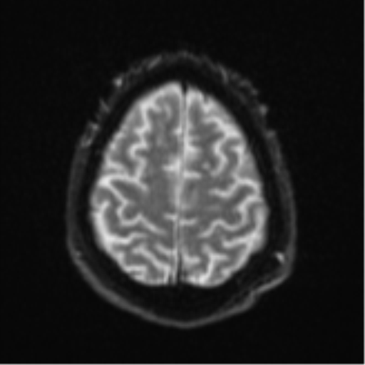 Cerebral embolic infarcts (embolic shower) (Radiopaedia 57395-64342 Axial DWI 30).png