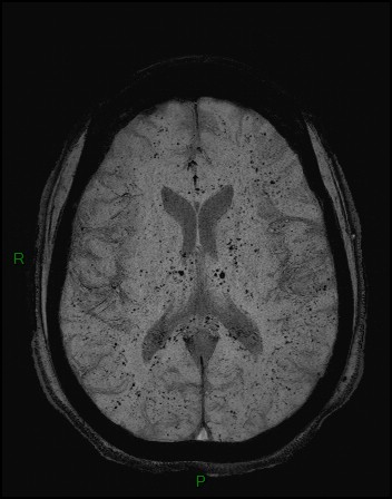 Cerebral fat embolism (Radiopaedia 35022-36525 Axial SWI 24).jpg
