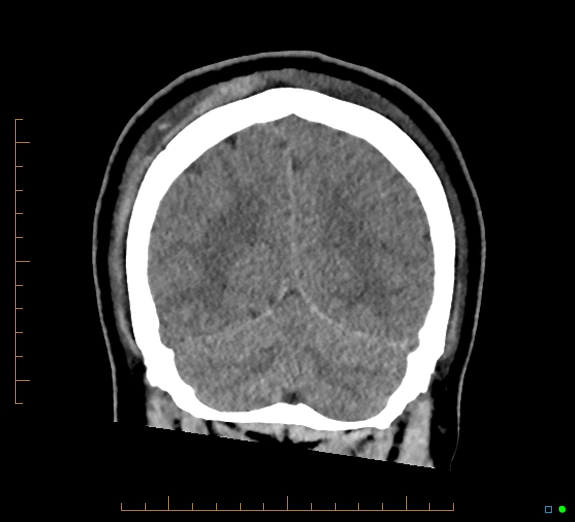 Cerebral fat embolism (Radiopaedia 85521-101224 Coronal non-contrast 49).jpg