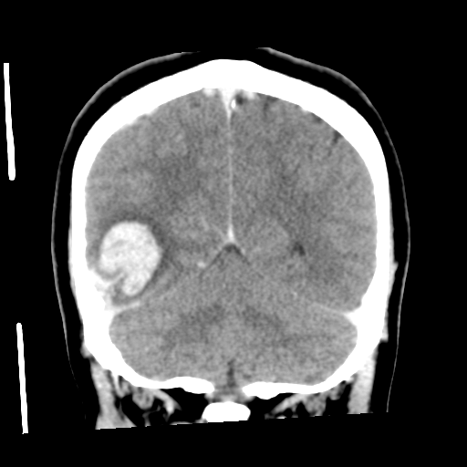 Cerebral hemorrhage secondary to arteriovenous malformation (Radiopaedia 33497-34561 C 49).png