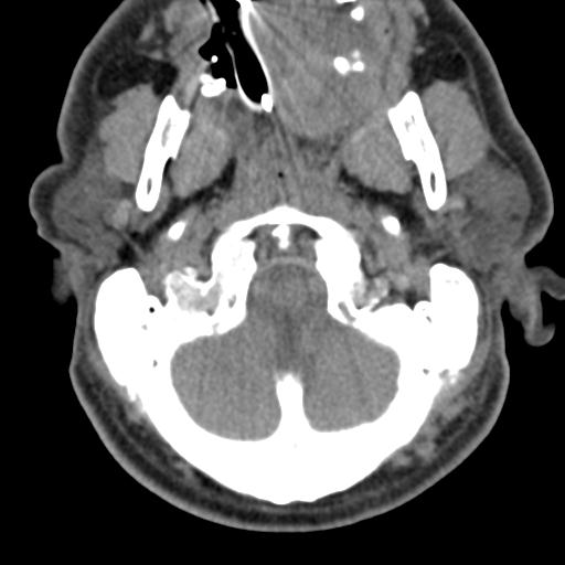 Cerebral hemorrhagic contusions and cervical spine fractures (Radiopaedia 32865-33841 F 9).jpg